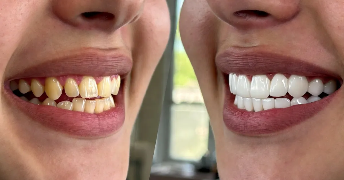 celebrities with teeth implants before and after